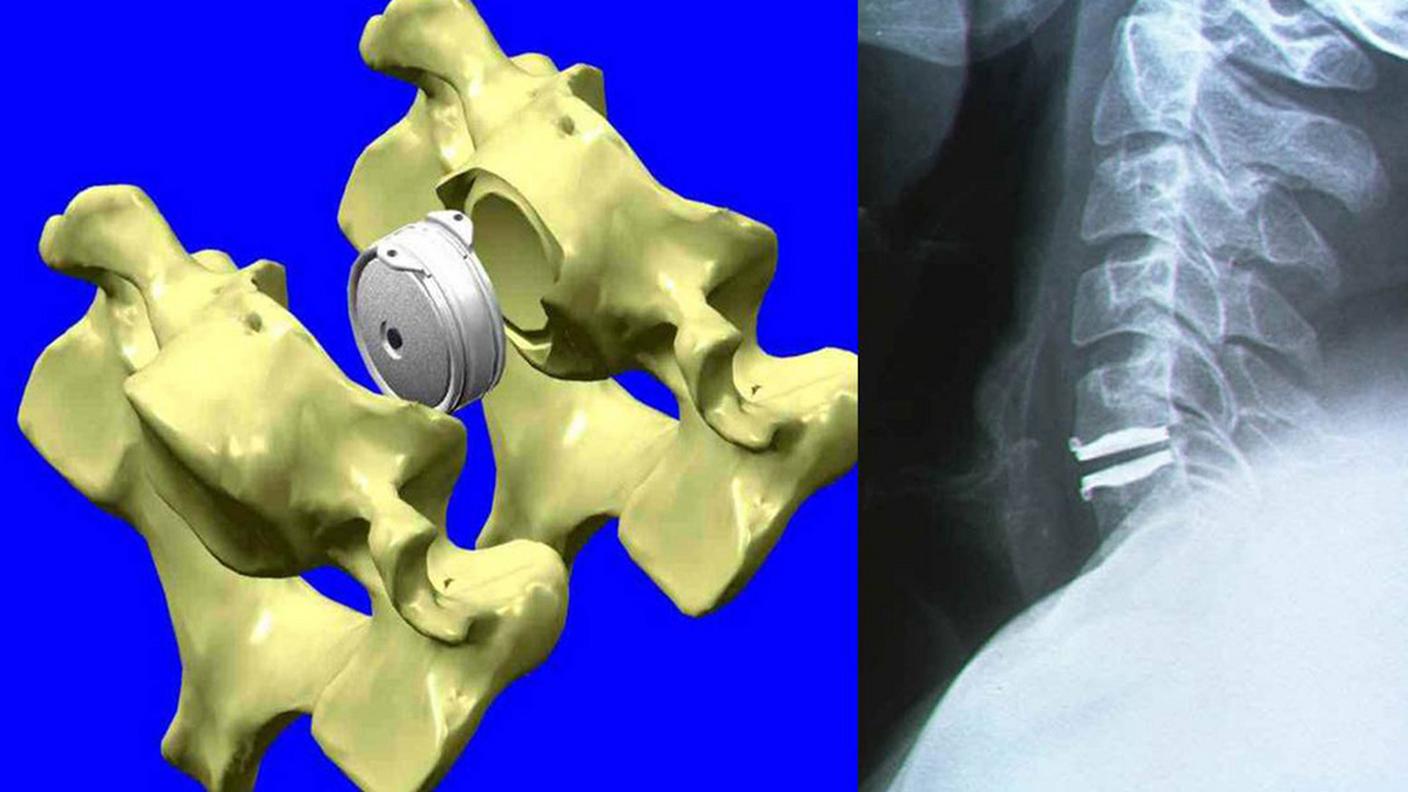 Il disco intervertebrale è l'articolazione più delicata per le protesi