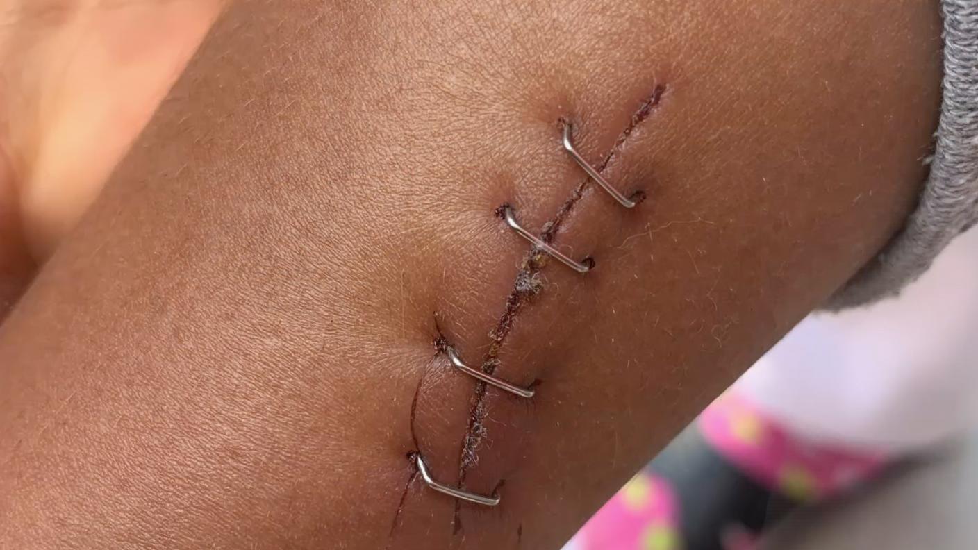 La cucitura di una lacerazione causata dal filo spinato a un bambino