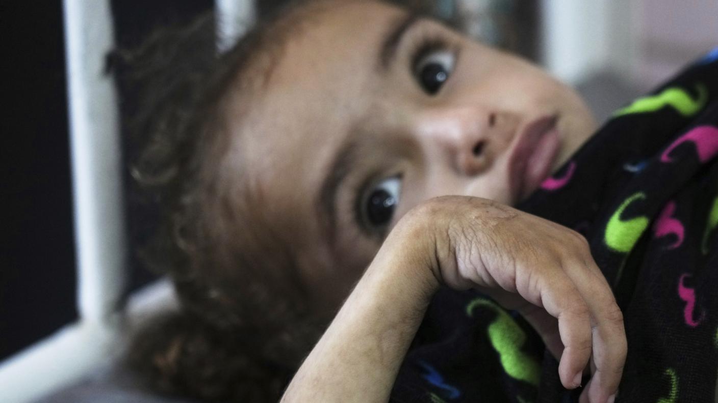 Una bimba di 2 anni affetta da malnutrizione, giace su un letto dell'ospedale Nasser, Khan Younis, Gaza, 21 maggio 2025