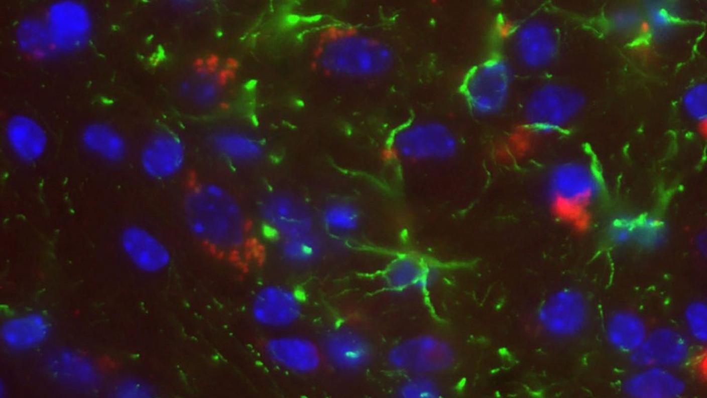 La perdita del cromosoma Y potrebbe portare all'Alzheimer