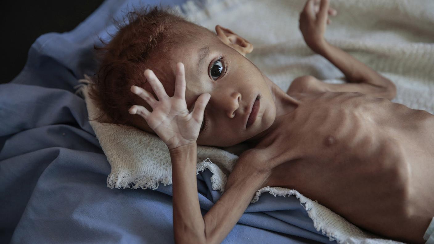 In Yemen i bambini colpiti dalla malnutrizione sono quasi 2 milioni