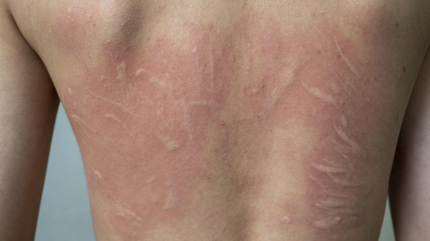 Da inizio pandemia fino alla scorsa settimana, Swissmedic ha ricevuto circa 1060 notifiche probabilmente correlate agli effetti collaterali riscontrati dopo la vaccinazione di richiamo o la terza dose.
